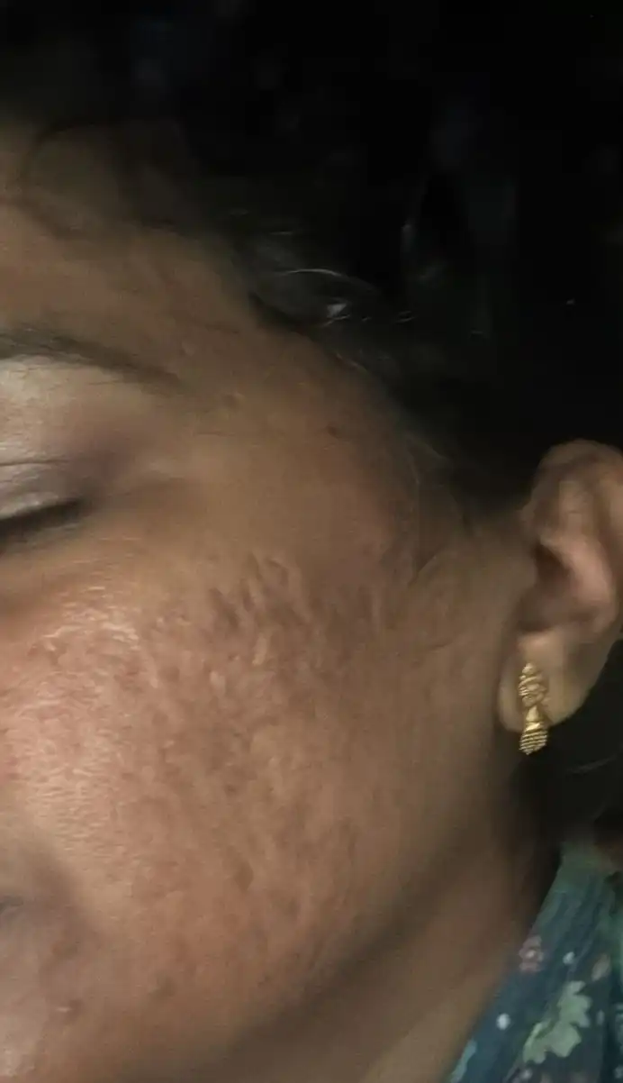 rolling acne scars